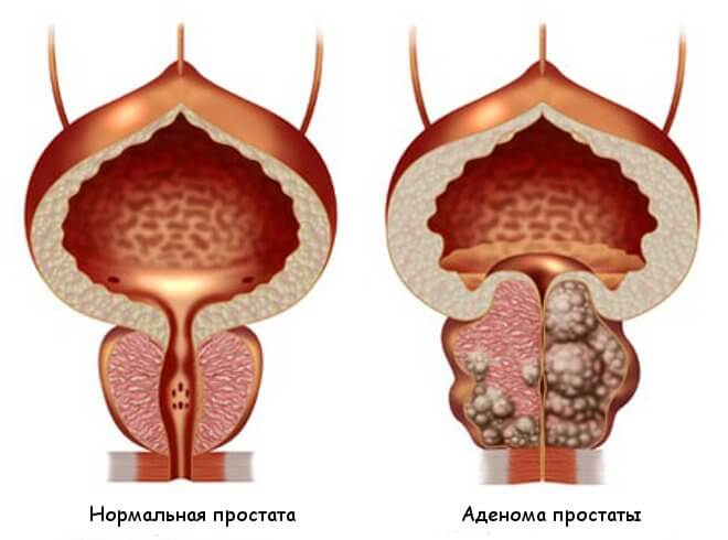 Купить витапрост форте свечи в воронеже