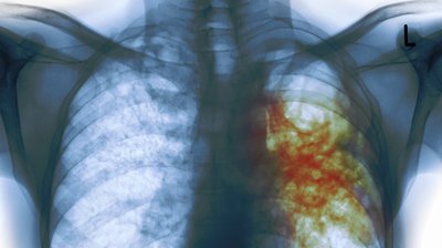 Туберкулез: причины и этиология заболевания