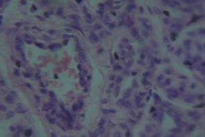 Микроскопическое строение капиллярной гемангиомы. Стенка капилляров представлена двух-трёхслойным эндотелием (тканевой атипизм), полость часто не заполнена кровью.
